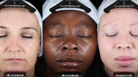 Lipotype and DSM: Lipid analysis for investigation of photodamaged dry facial skin from different ethnic groups.