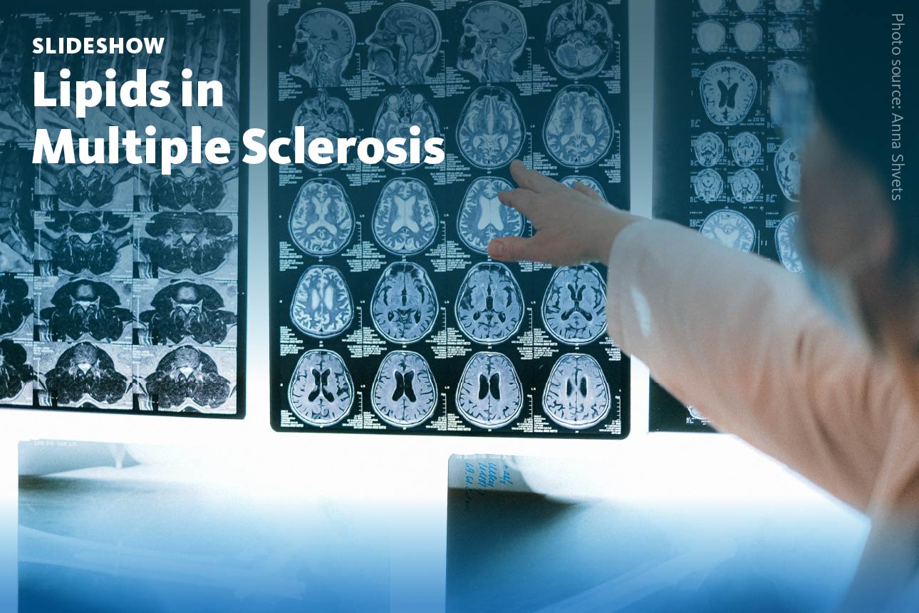 Slide 1: A slideshow about lipid biomarkers for improved diagnosis and monitoring of multiple sclerosis.