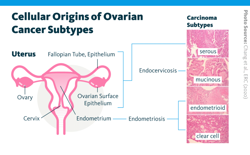 An infographic showing the cellular origins of serous ovarian cancer, mucinous ovarian cancer, endometrioid ovarian cancer, and clear cell ovarian cancer.