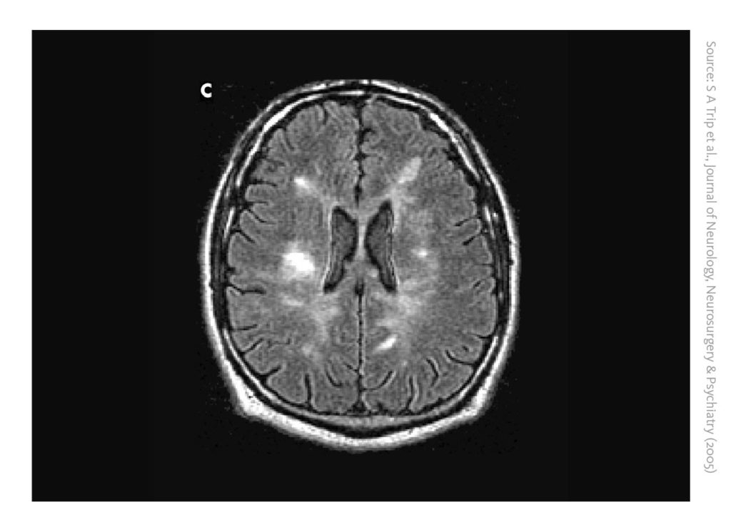 A scientific image depicting a brain MRI of a 30 year old man with relapsing remitting multiple sclerosis showing multiple lesions (white signals).