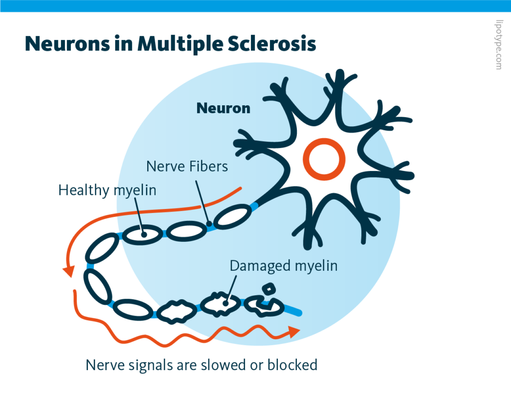 An infographic showing how neurons and their myelin sheaths are affected by multiple sclerosis, a chronic inflammatory and neurodegenerative disease of the central nervous system.