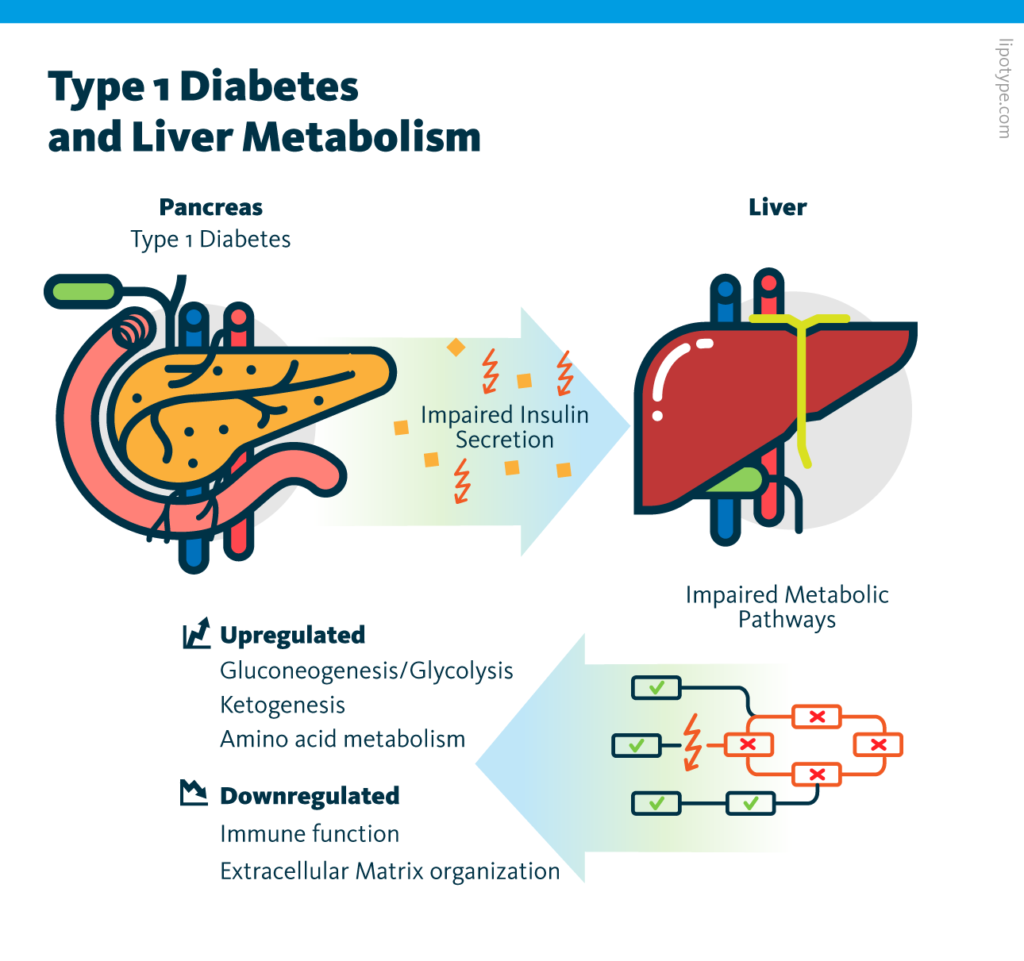 An infographic showing how poorly controlled insulin deficiency in type 1 diabetes causes long-term consequences for the liver and impairs metabolic pathways.