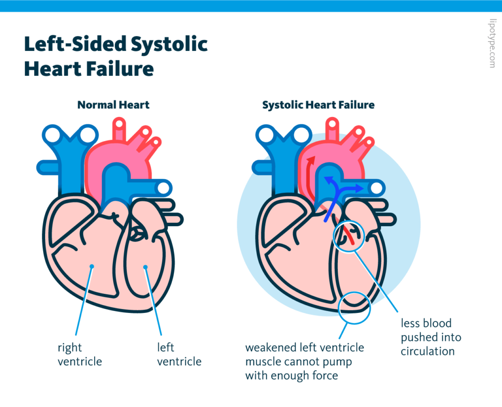 An infographic comparing a normal, healthy heart and a heart affected by left-sided systolic heart failure. The left ventricle muscle is weakened, thus pushing less blood into circulation.