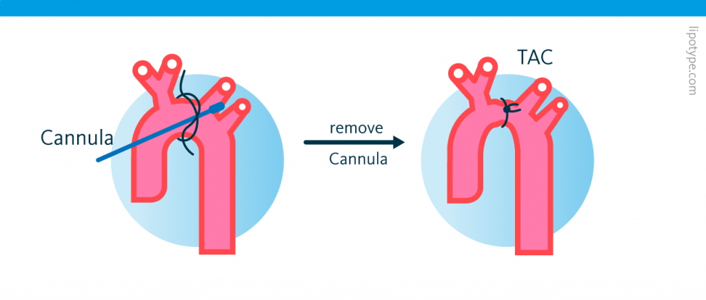 A schematic depicting the surgical process for constriction of the transverse aortic arch. to replicate heart failure in mice.