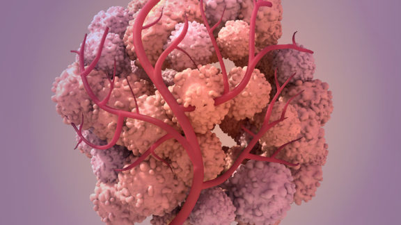 A scientific computer render of vascularized cancer tissue.