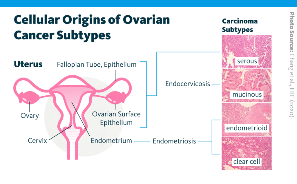 An infographic showing the cellular origins of serous ovarian cancer, mucinous ovarian cancer, endometrioid ovarian cancer, and clear cell ovarian cancer. An infographic showing the cellular origins of serous ovarian cancer, mucinous ovarian cancer, endometrioid ovarian cancer, and clear cell ovarian cancer.