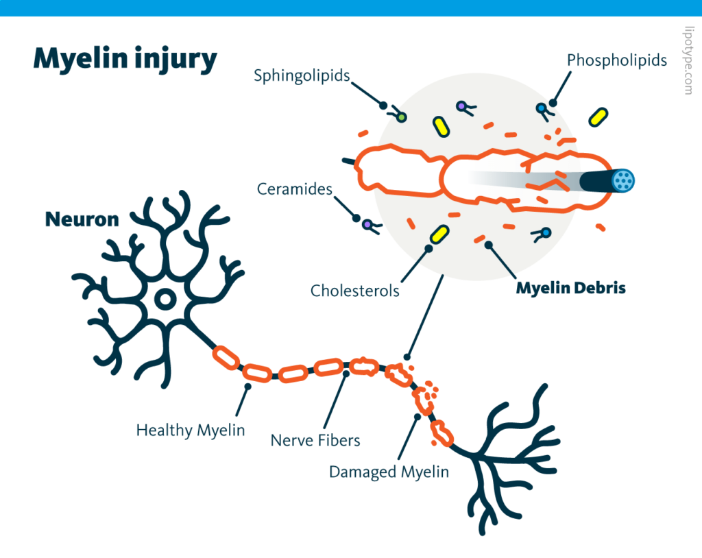 An infographic depicting the lipid content of damaged myelin: sphingolipids, ceramides, cholesterol, phospholipids, and myelin debris.
