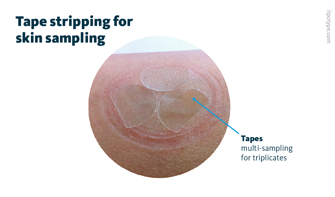 Skin tape stripping as a non-invasive method for skin sampling: Tape stripping for skin sampling involves the application of a specialized adhesive tape disc onto a specific area of the body. After a brief period of pressure, the tape is removed, with the skin adhering to it. This process allows for the extraction of sebum lipids and stratum corneum lipids, which can be subsequently analyzed in lipidomics studies. Applying multiple tapes to the same spot at once enables quick triplicate sampling, while sequential tape stripping permits an analysis of skin depth.