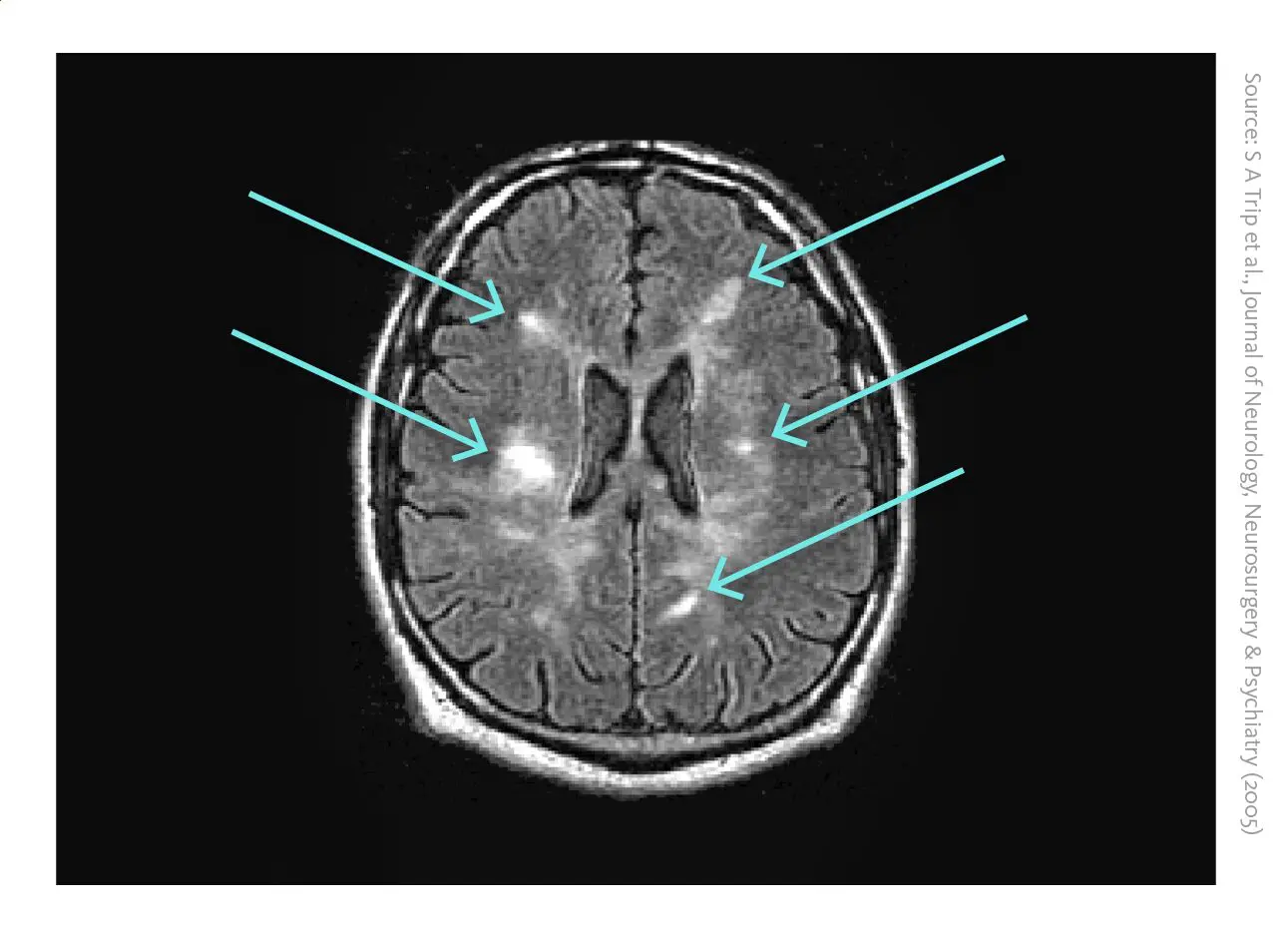 MRI of a brain affected by multiple sclerosis: The brain MRI of a 30-year-old man with relapsing remitting multiple sclerosis shows multiple lesions (white signals pointed out with arrows).