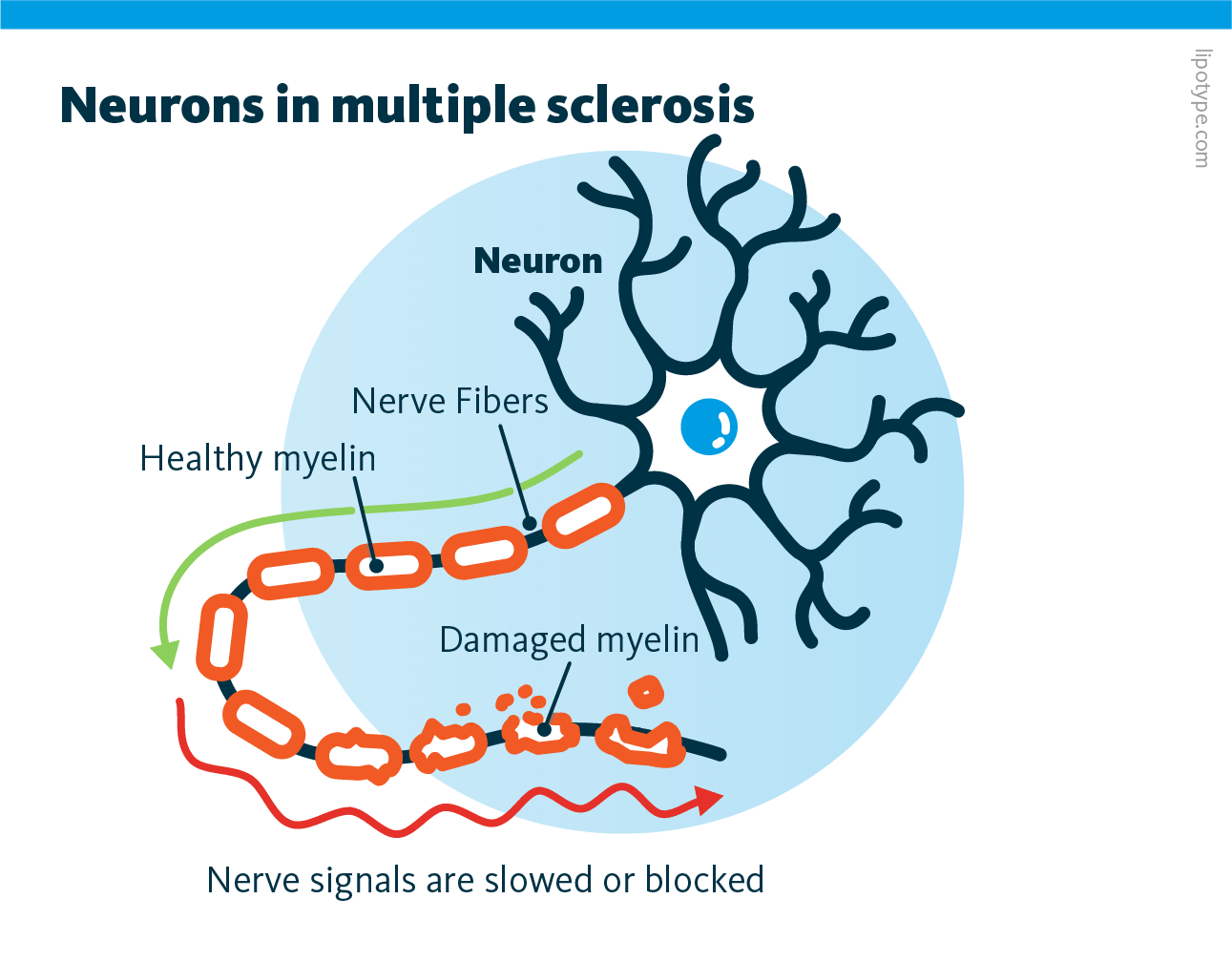 An infographic showing how neurons and their myelin sheaths are affected by multiple sclerosis, a chronic inflammatory and neurodegenerative disease of the central nervous system.
