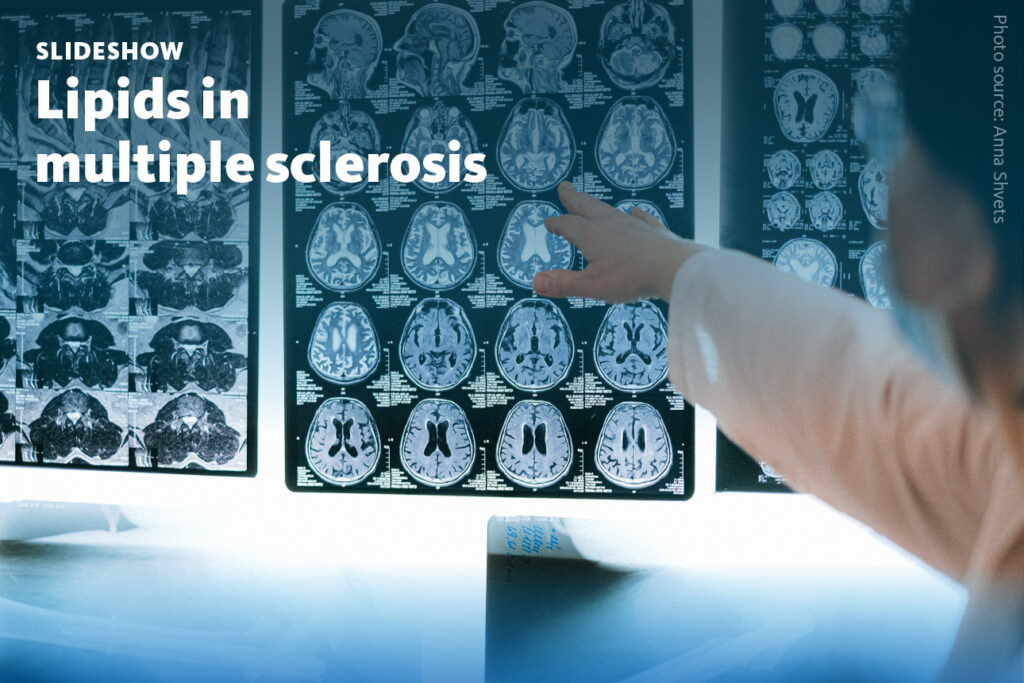 Slide 1: A slideshow about lipid biomarkers for improved diagnosis and monitoring of multiple sclerosis.