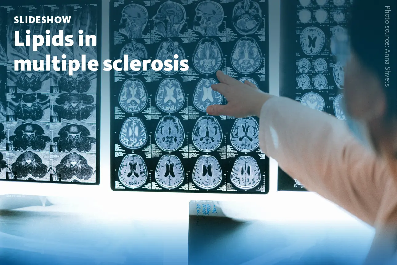 Slide 1: A slideshow about lipid biomarkers for improved diagnosis and monitoring of multiple sclerosis.