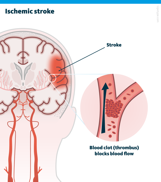 Mechanism underlying ischemic stroke