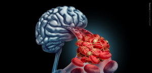 A graphic showing a brain, a blood vessel with erythrocytes, and a forming blood clot.