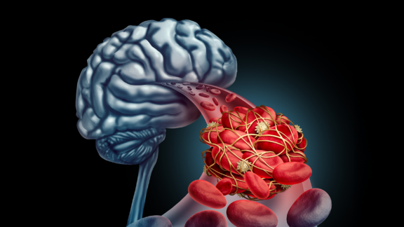 A graphic showing a brain, a blood vessel with erythrocytes, and a forming blood clot.