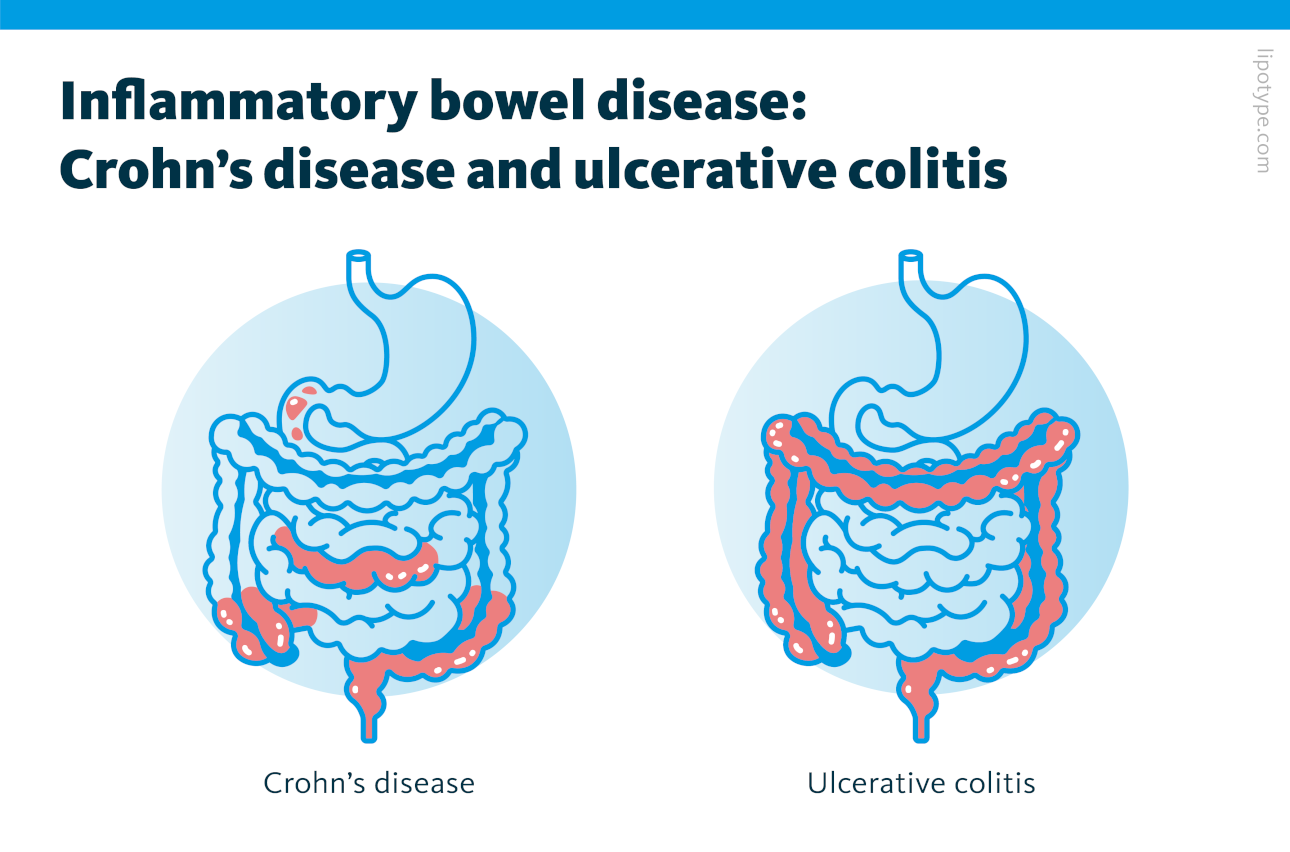 Inflammatory bowel disease (IBD) is a condition that causes inflammation in the intestines, either in scattered inflammation areas throughout the digestive tract (Crohn’s disease) or continuously in the colon (ulcerative colitis). 