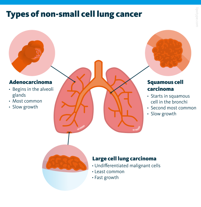 Non-small cell lung cancer (NSCLC) can be subdivided into three main subtypes: adenocarcinoma, large cell lung carcinoma, and squamous cell carcinoma.