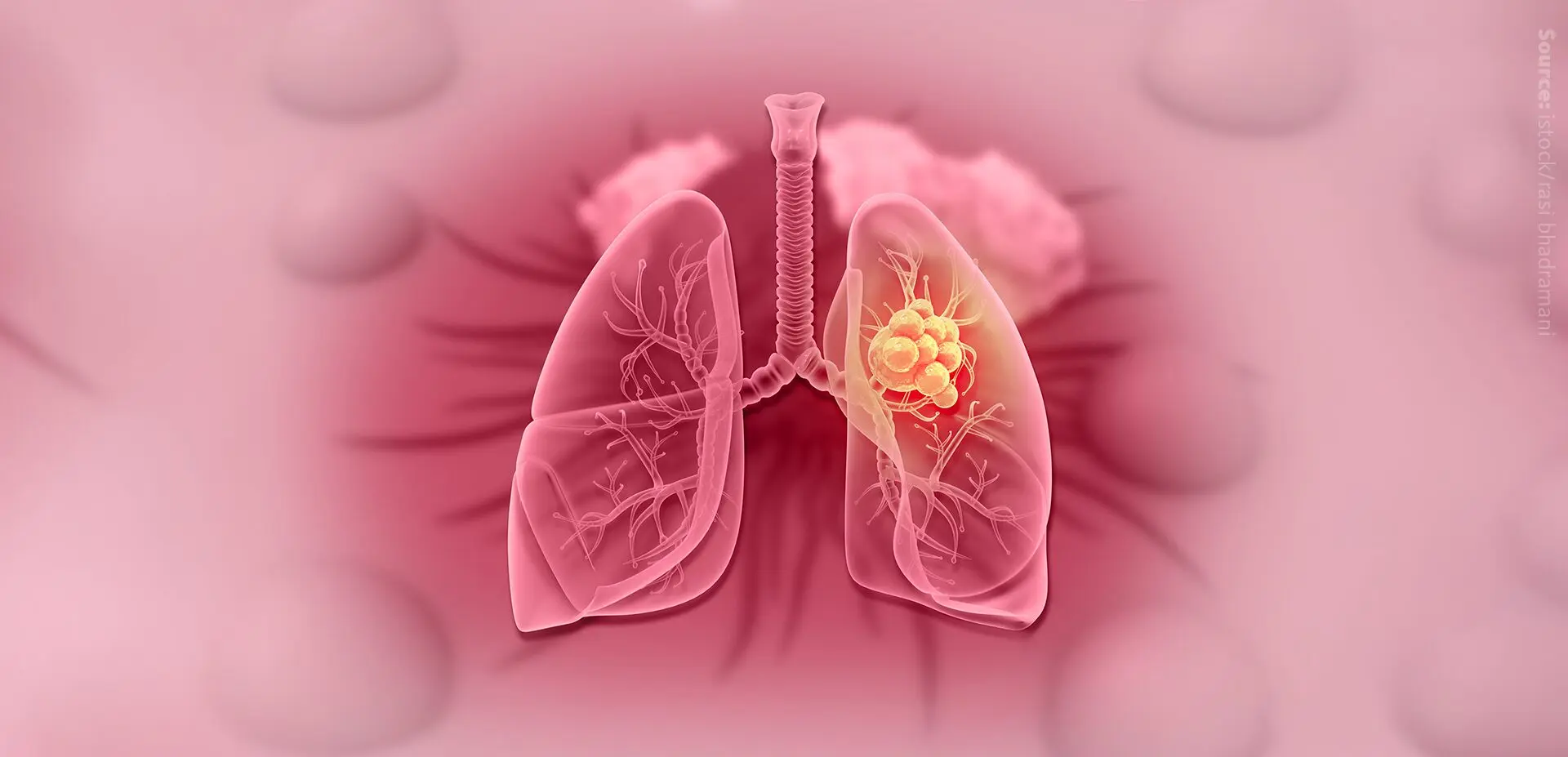 Lipids affect lung cancer growth