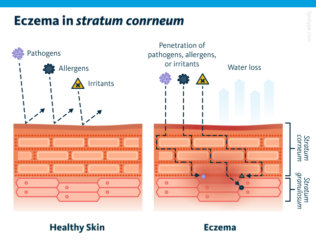 Eczema in stratum corneum