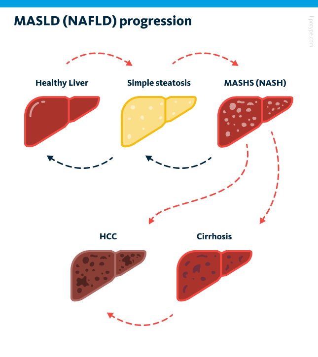 MASLD (NAFLD) progression