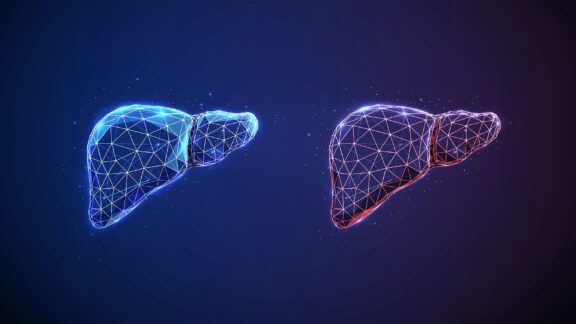 Phospholipid remodelling in fatty liver disease
