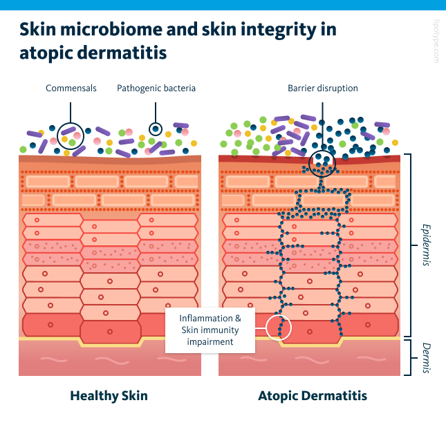 Skin microbiome and skin integrity in atopic dermatitis